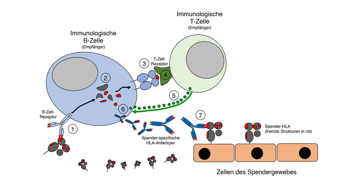 Interaction des anticorps HLA spécifiques du donneur avec les cellules immunitaires du receveur